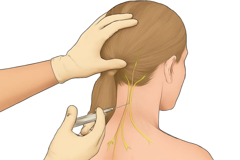 Occipital nerve block procedure showing injection sites at base of skull