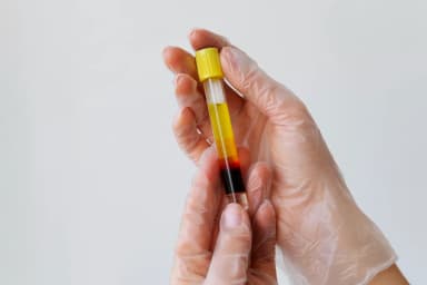 PRP Therapy diagram showing platelet concentration process