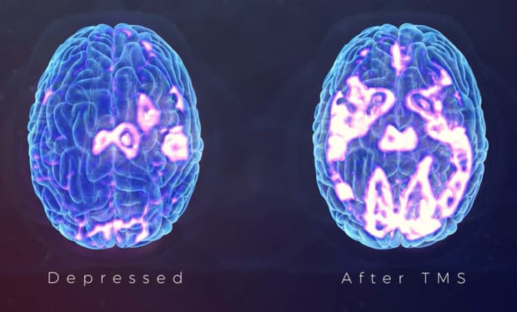 Brain scan comparison showing post-TMS treatment results