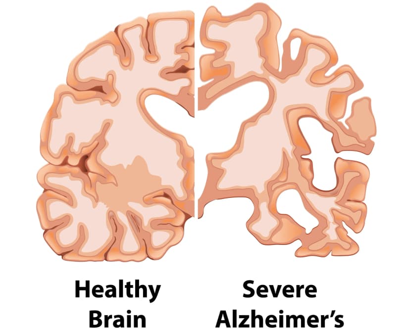 Medical scan illustrating neurodegenerative changes