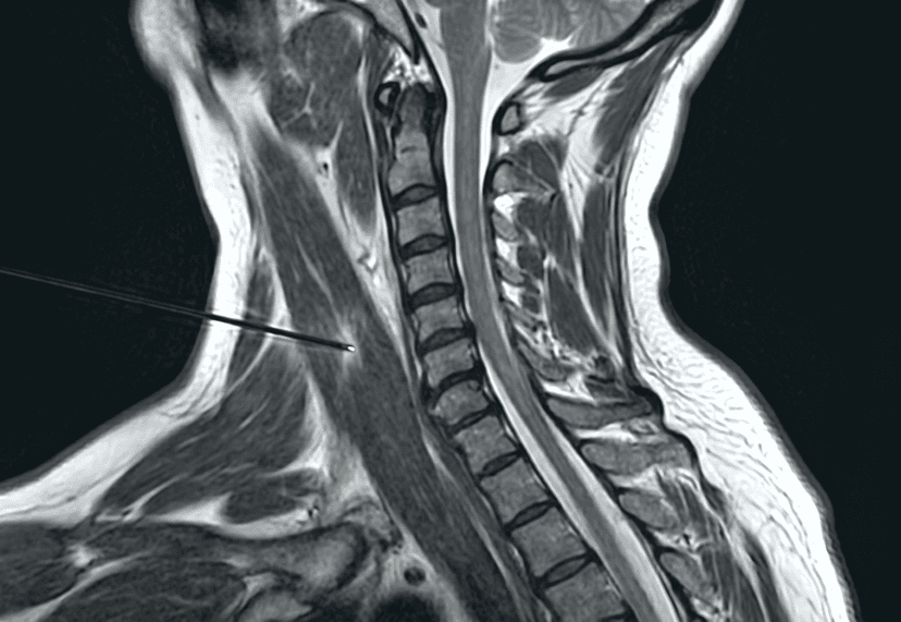 Botox for Cervical Dystonia