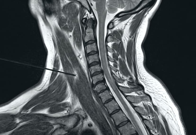Botox for Cervical Dystonia