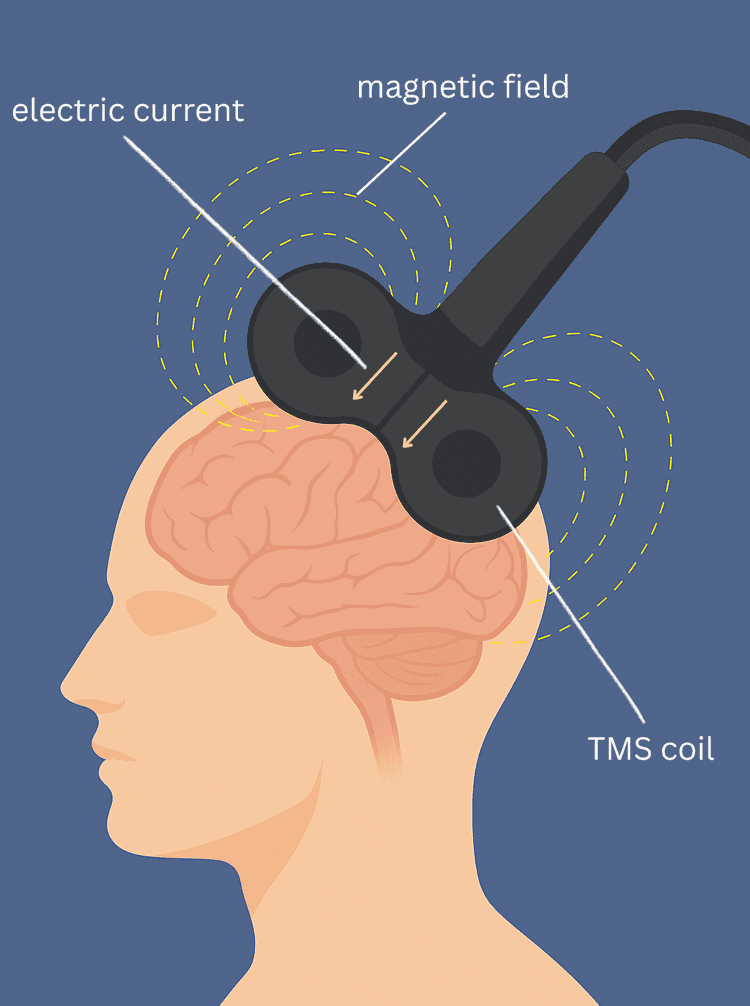 Diagram showing how Brain TMS works using electromagnetic pulses