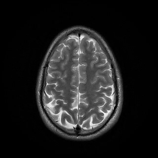 Brain MRI scan showing neurological details