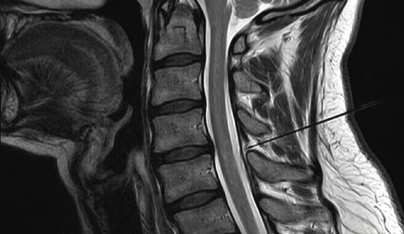 Cervical Facet Injection