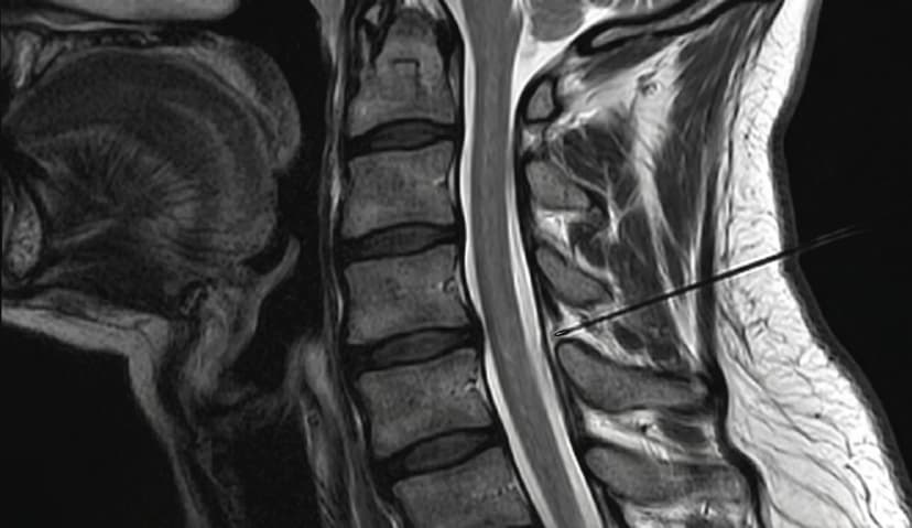 Cervical Facet Injection