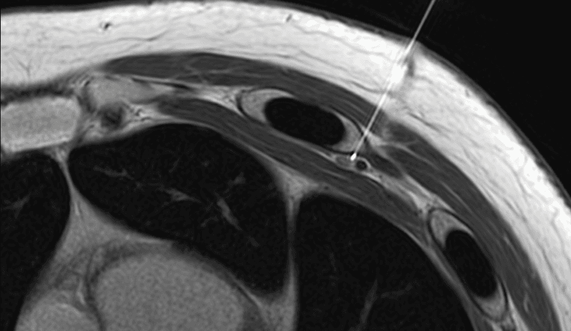 Intercostal Nerve Block