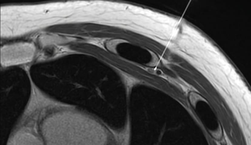 Intercostal Nerve Block