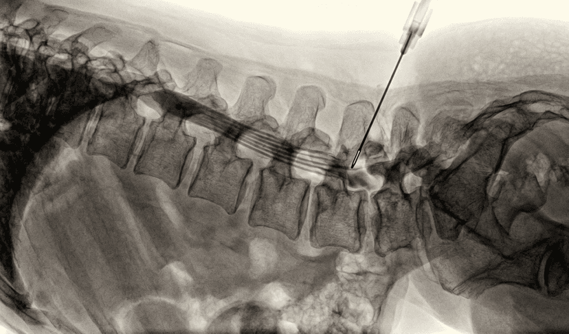 Lumbar Epidural Injection
