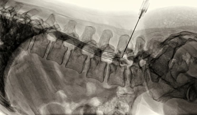 Lumbar Epidural Injection
