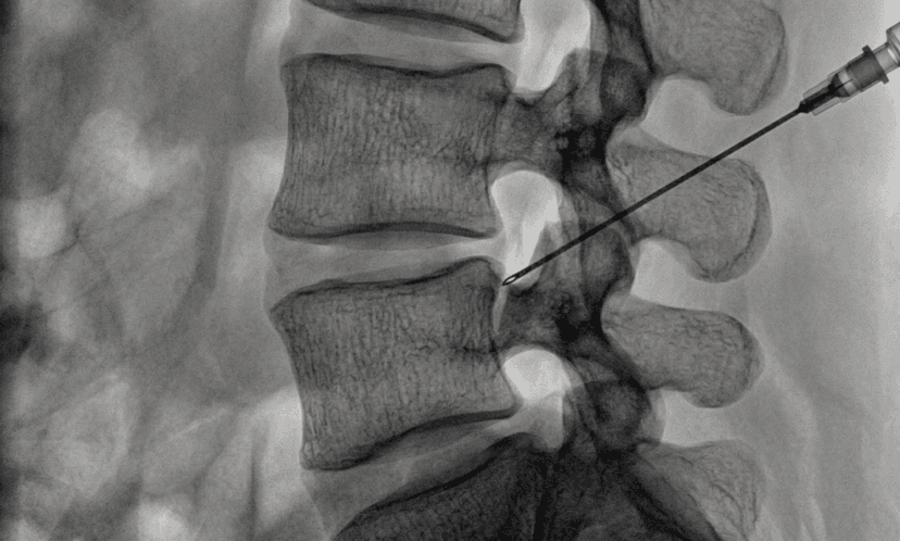 Lumbar Facet Injection