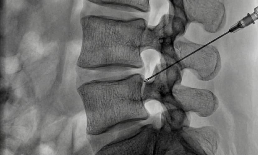 Lumbar Facet Injection