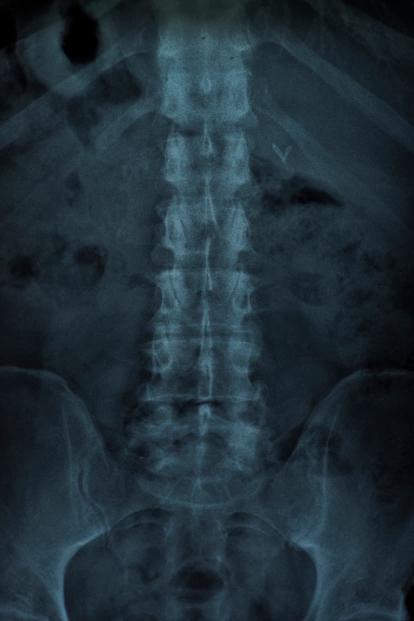 Lumbar MRI showing spine anatomy