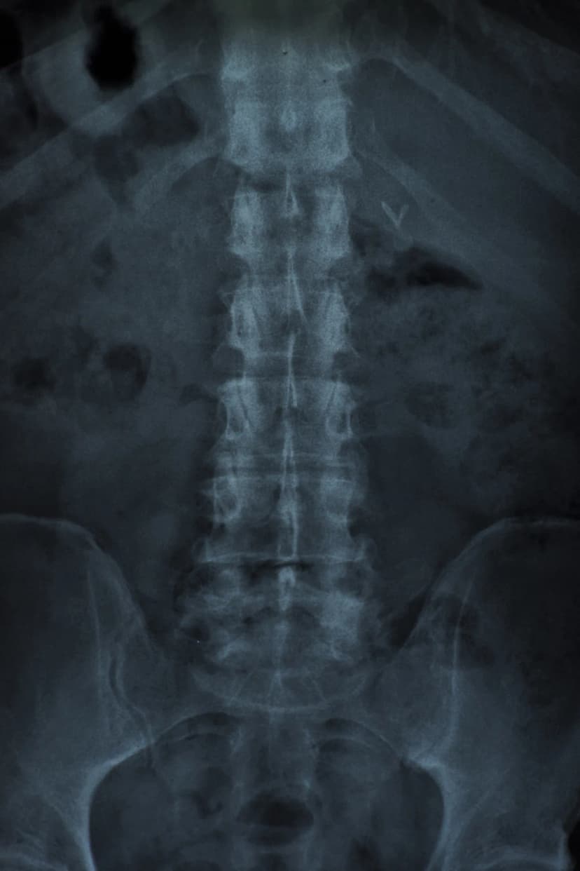 Lumbar MRI showing spine anatomy