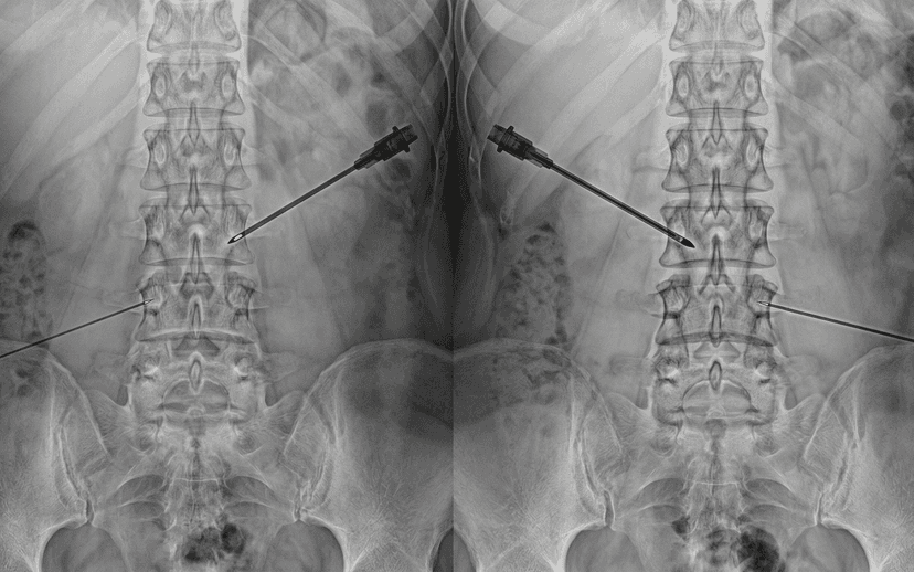 Medial Branch Block with Radiofrequency Ablation
