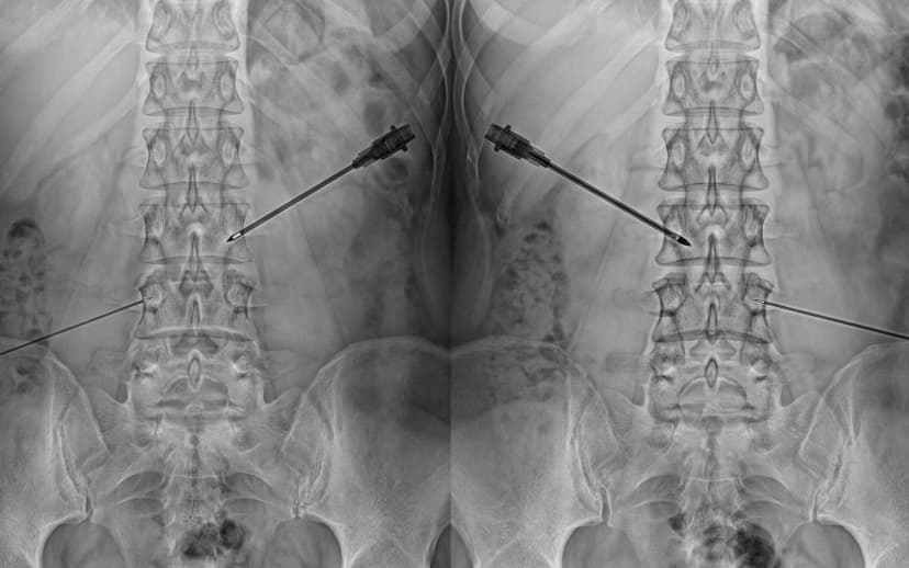Medial Branch Block with Radiofrequency Ablation