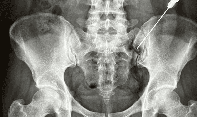 SI Joint Injection