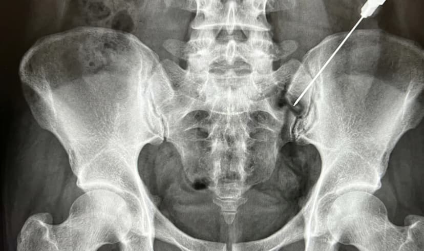 SI Joint Injection
