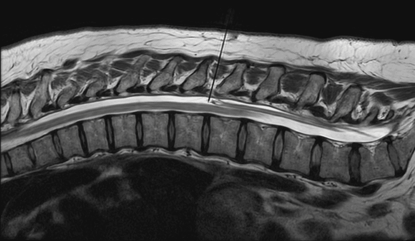 Thoracic Epidural Injection