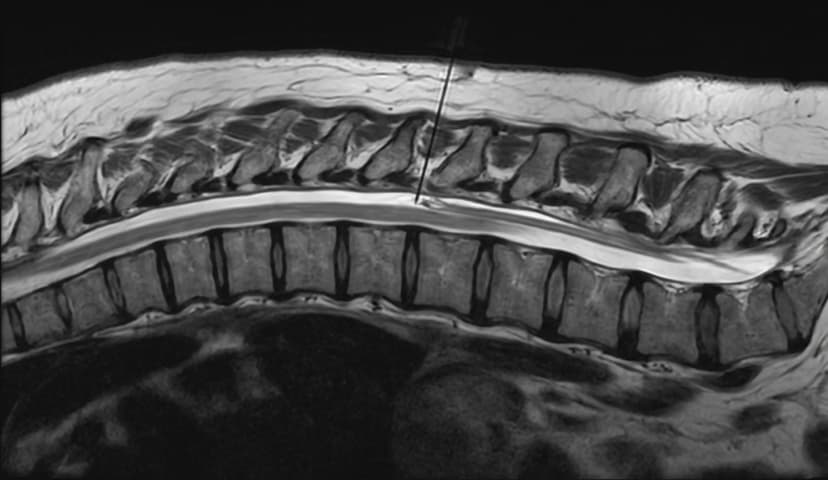 Thoracic Epidural Injection