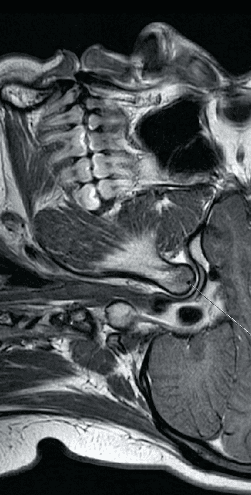 Temporomandibular Joint Injection