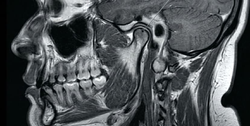 Temporomandibular Joint Injection